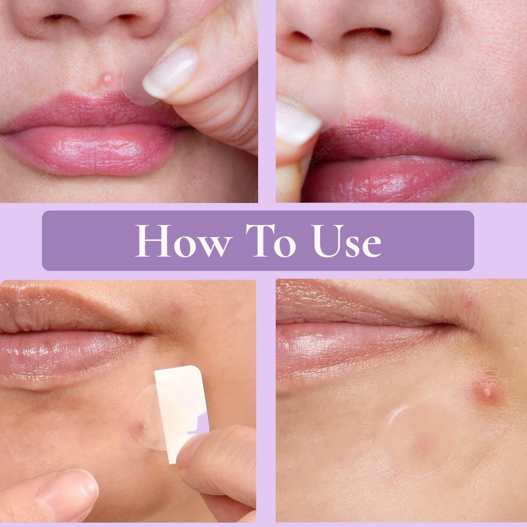 OurPatches™ Pimple Patches — Clear, Heal & Protect