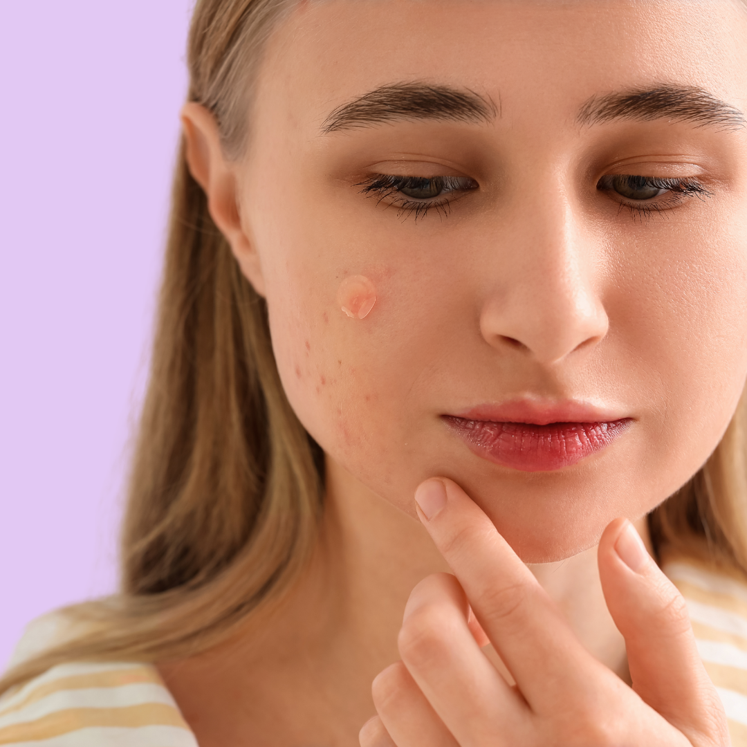 OurPatches™ Pimple Patches — Clear, Heal & Protect